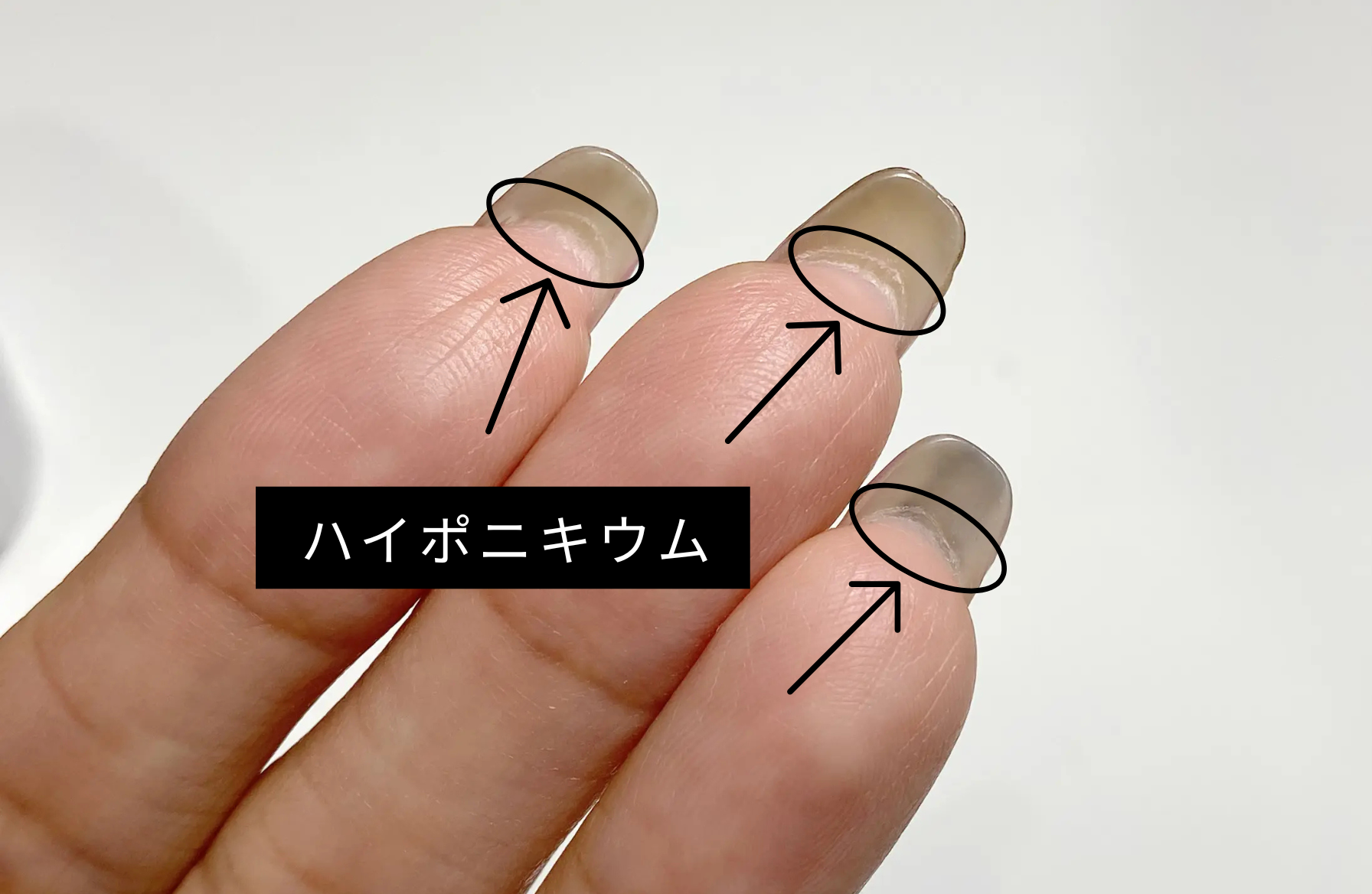 ハイポニキウム