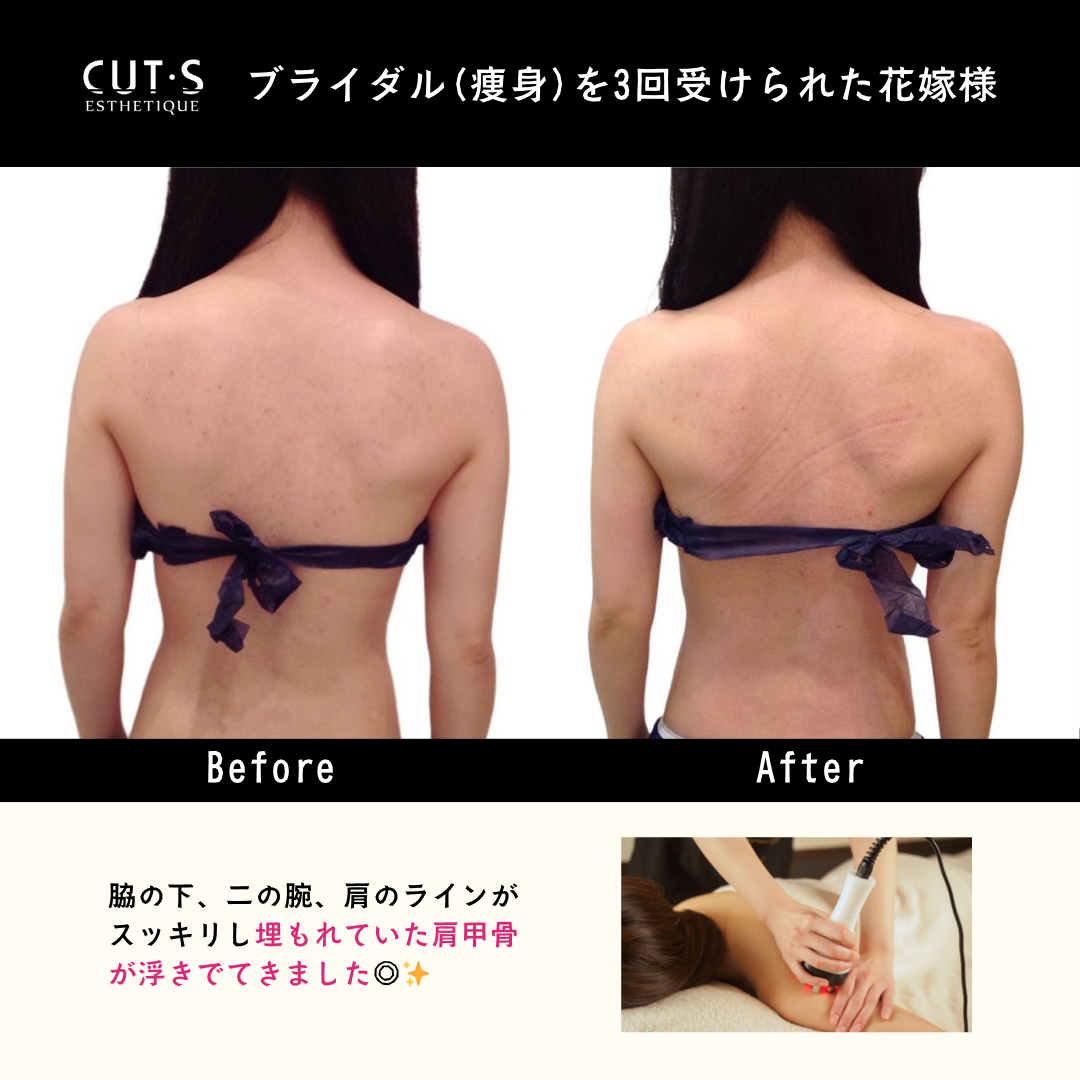 ブライダル痩身beforeafter